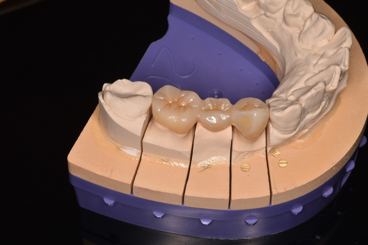 つめ物・かぶせ物