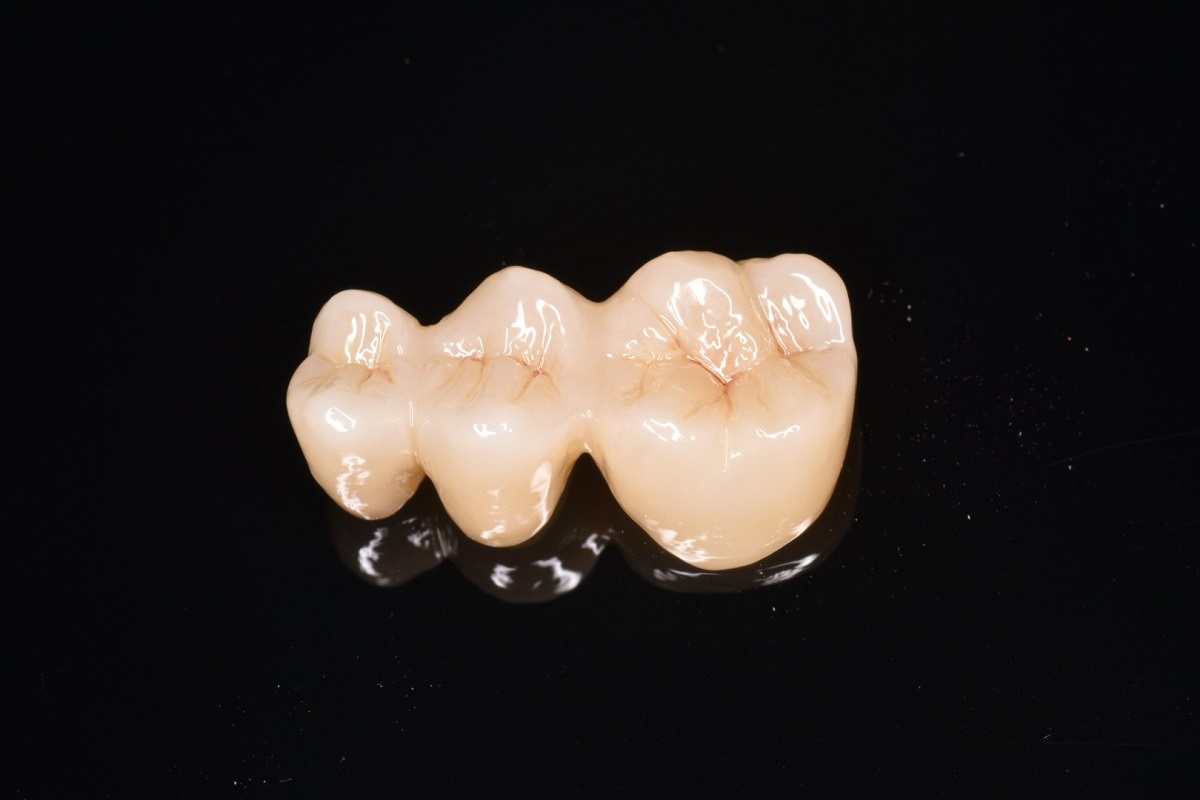 松原歯科医院のつめ物・かぶせ物